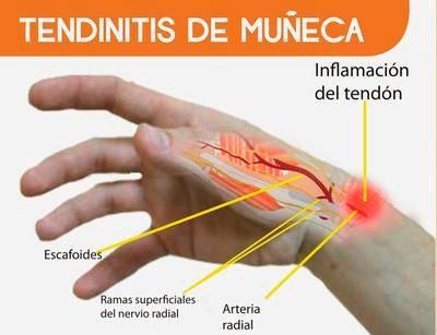 que es la tendinitis como se cura